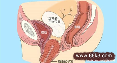 全程干货（治愈子宫脱垂特效方）子宫脱垂特效验方，子宫脱垂治疗奇效良方三则，