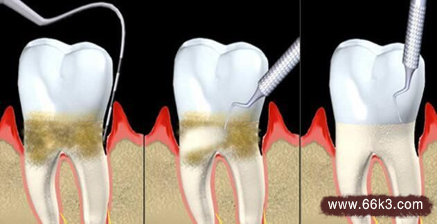 牙周炎如何治-祖传特效偏方治疗牙周炎